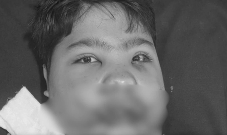 फ्रिज खोलते ही हुआ ब्लास्ट... बच्चे की 108 हड्डियां टूटी, 5 घंटे सर्जरी कर बचाई जान