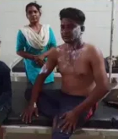 पत्नी की दरिंदगी: सो रहे पति पर उड़ेला खौलता पानी, हथौड़े से किया हमला, बोला- रोज करती है मारपीट