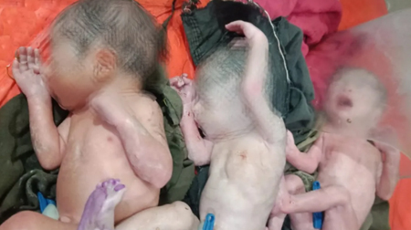 महिला ने तीन प्रीमेच्योर बच्चों को दिया जन्म, डॉक्टर कर रहे निगरानी